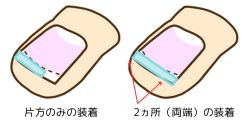 巻き爪装着図