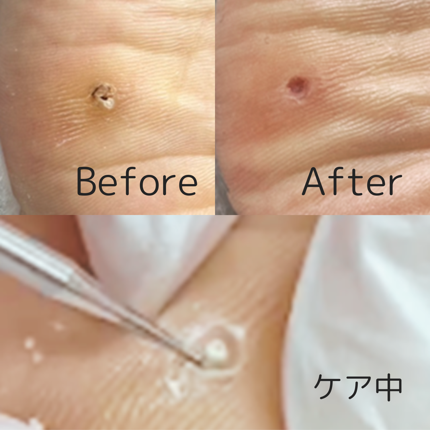 ウオノメケアBefore After