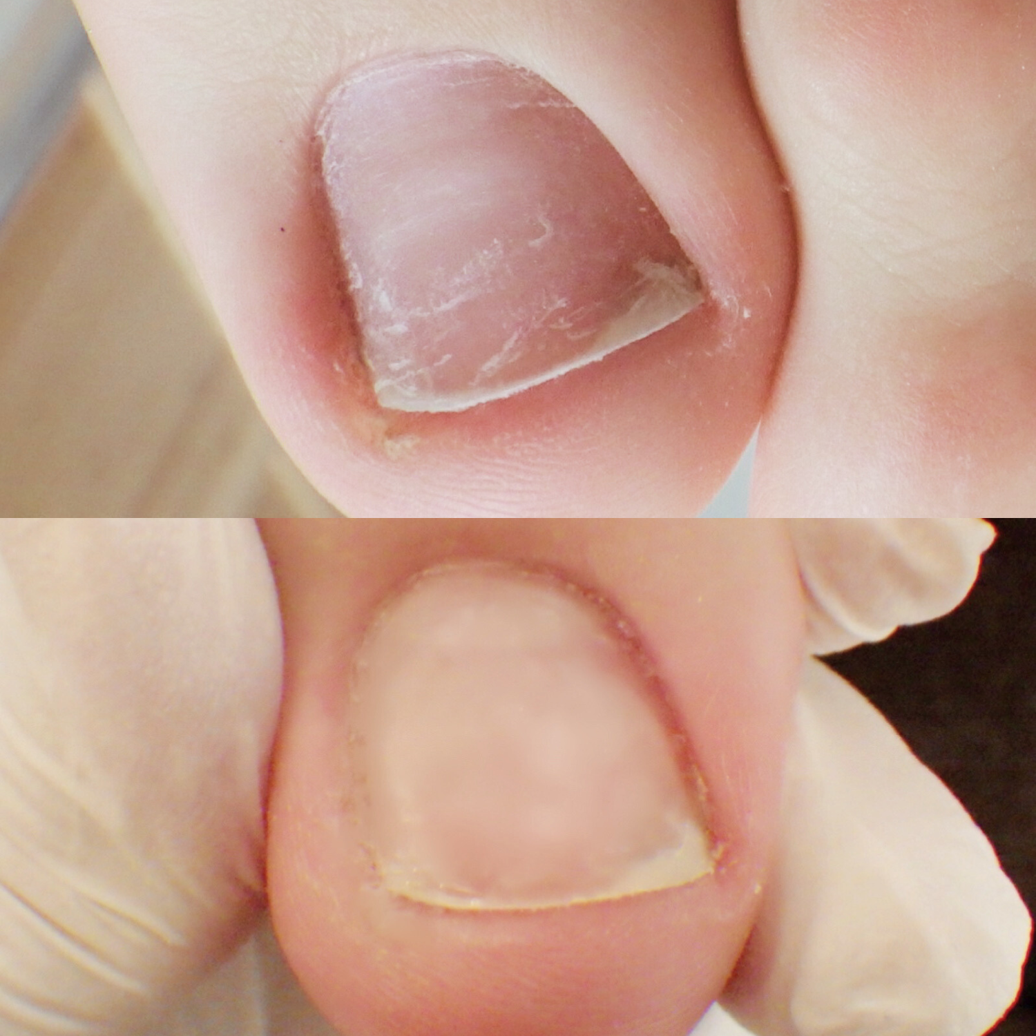 陥入爪ケア Before After