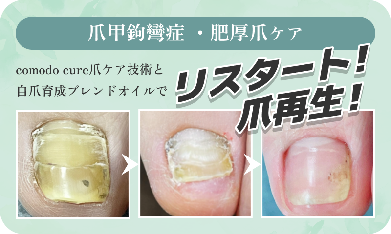 爪甲鉤彎症・肥厚爪ケア