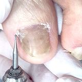 爪甲鉤彎症（リスタートケア）