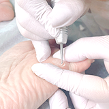 タコ・ウオノメ