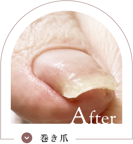巻き爪ケア