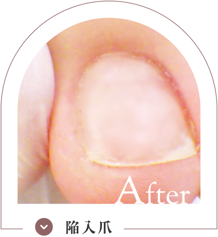 陥入爪ケア