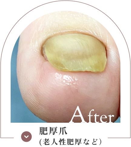 肥厚爪（老人性肥厚など）