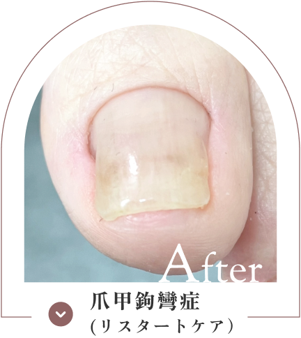 爪甲鉤彎症（リスタートケア）