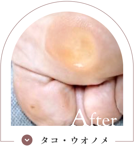 タコ・ウオノメ