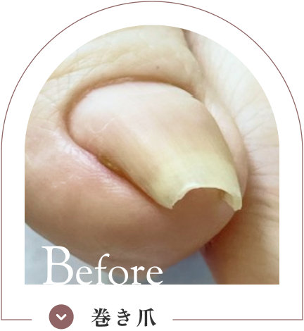 巻き爪ケア