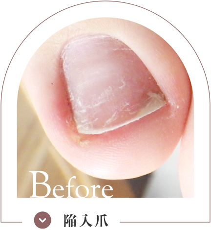 陥入爪ケア