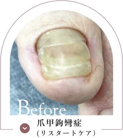 爪甲鉤彎症（リスタートケア）