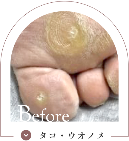 タコ・ウオノメ