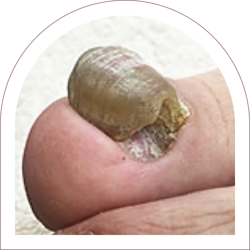 肥厚爪（老人性肥厚など）