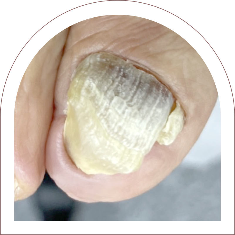 爪甲鉤彎症（リスタートケア）