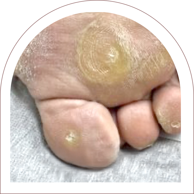 タコ・ウオノメ