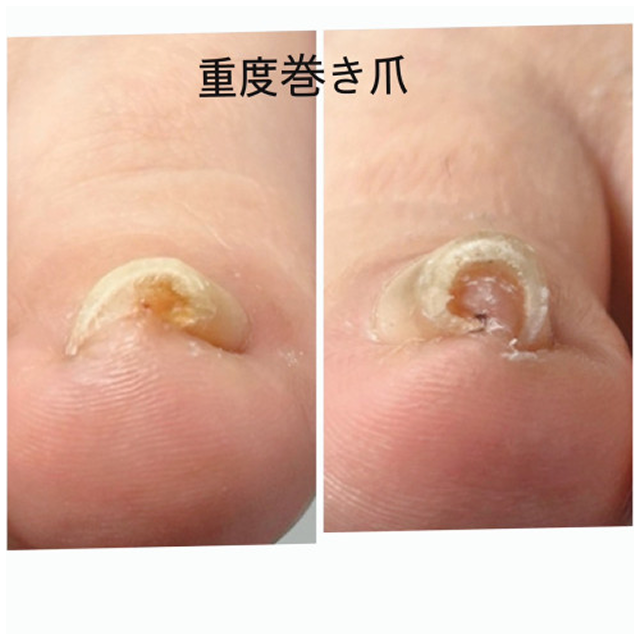 重度巻き爪