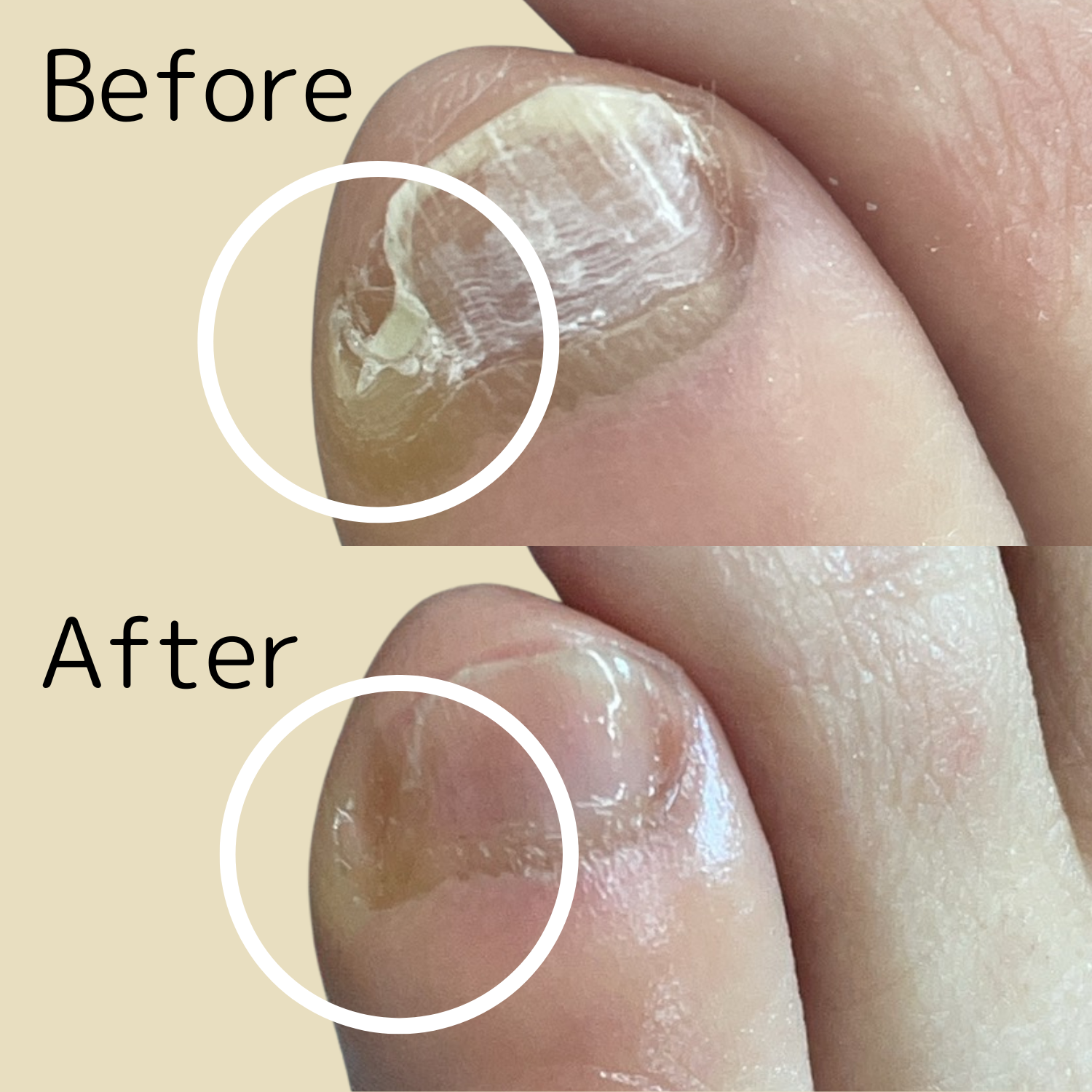 副爪ケア Before After