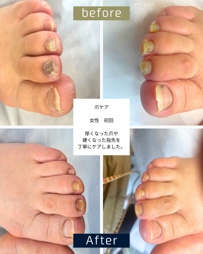 爪ケア