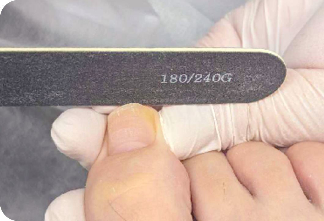 爪ケアプログラム