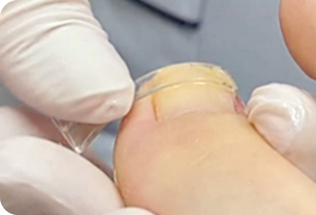 巻き爪ケアプログラム