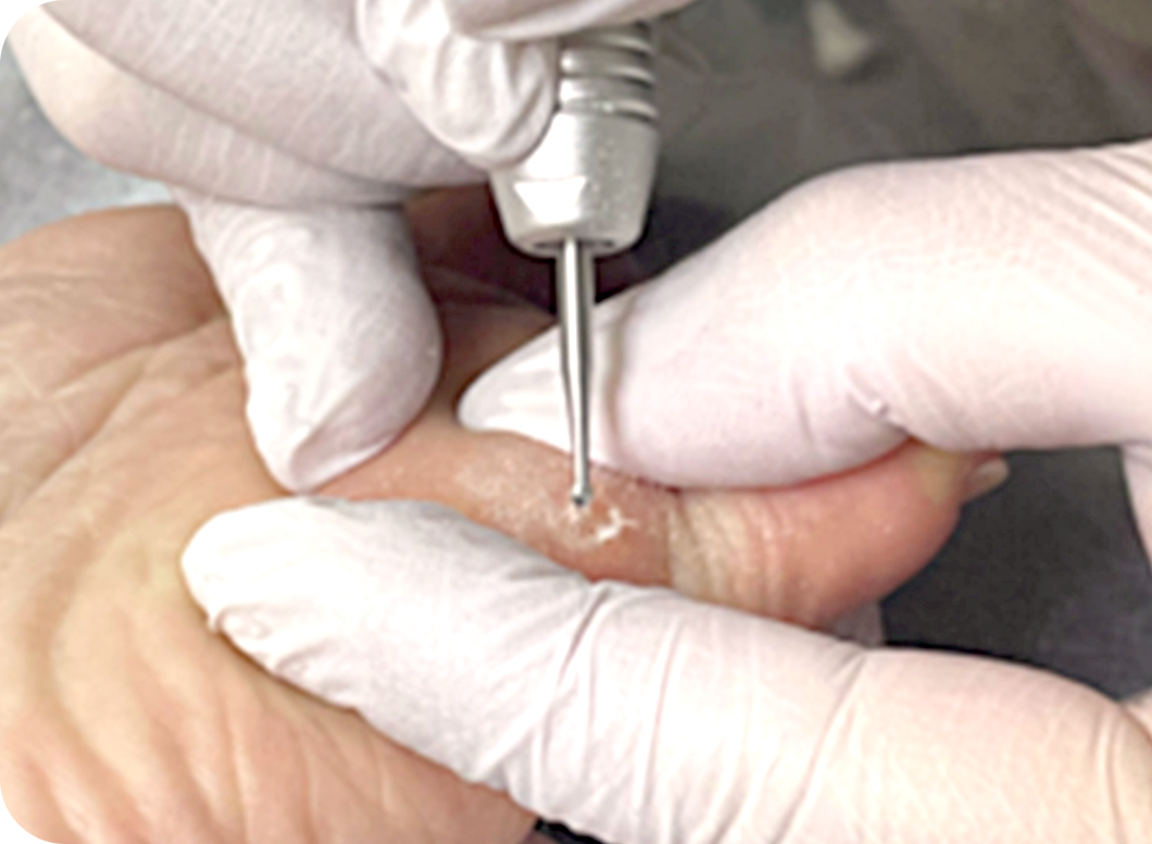 角質ケアプログラム