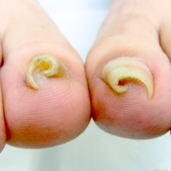 重度巻き爪ケアコース