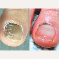 爪甲鉤彎症リスタートケアコース