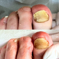 爪甲鉤彎症ケアコース