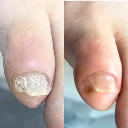 副爪・育爪ケアコース