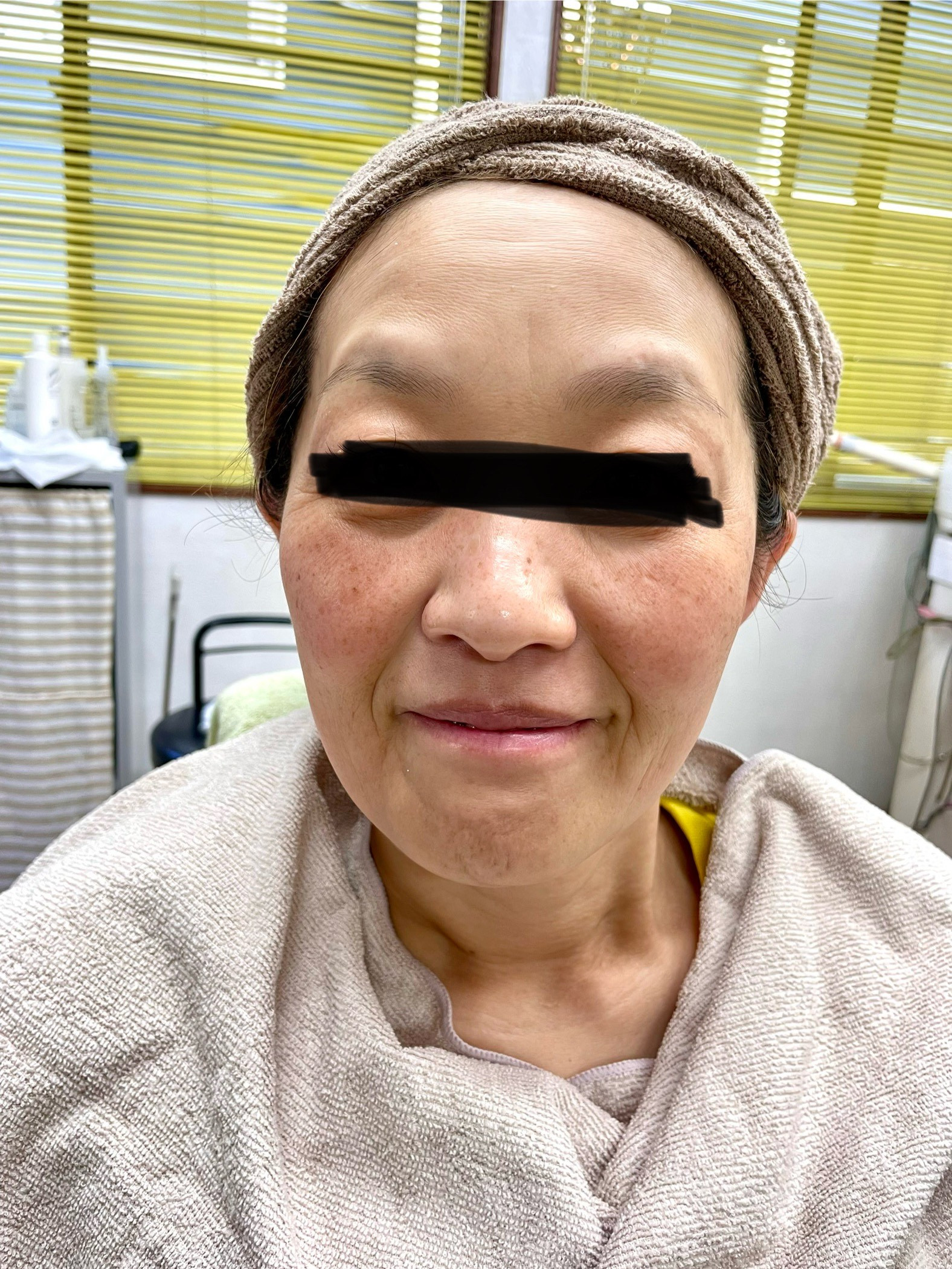 みかさんパック後.JPG