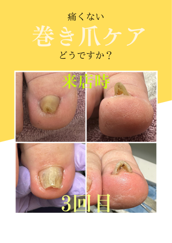 巻き爪で困っているあなた