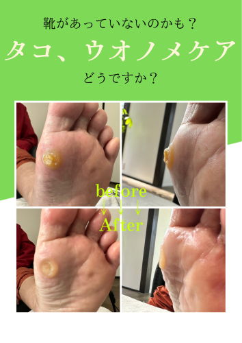 たこ、ウオノメケア