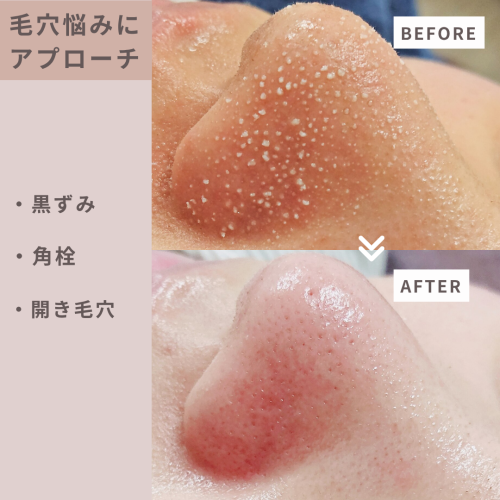 ピンク シンプル エステ ビフォーアフター インスタグラム投稿  - 1.png