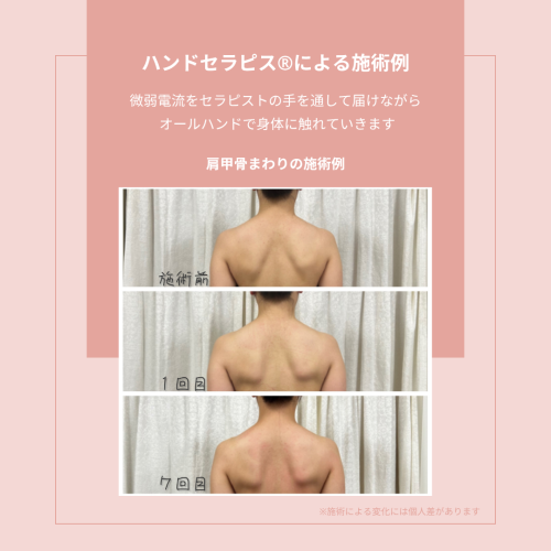 ハンドセラピスによる肩甲骨まわりの施術例