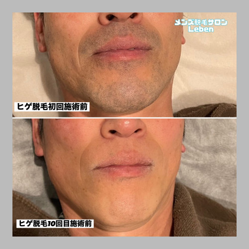 青ヒゲ嫌じゃないですか？？