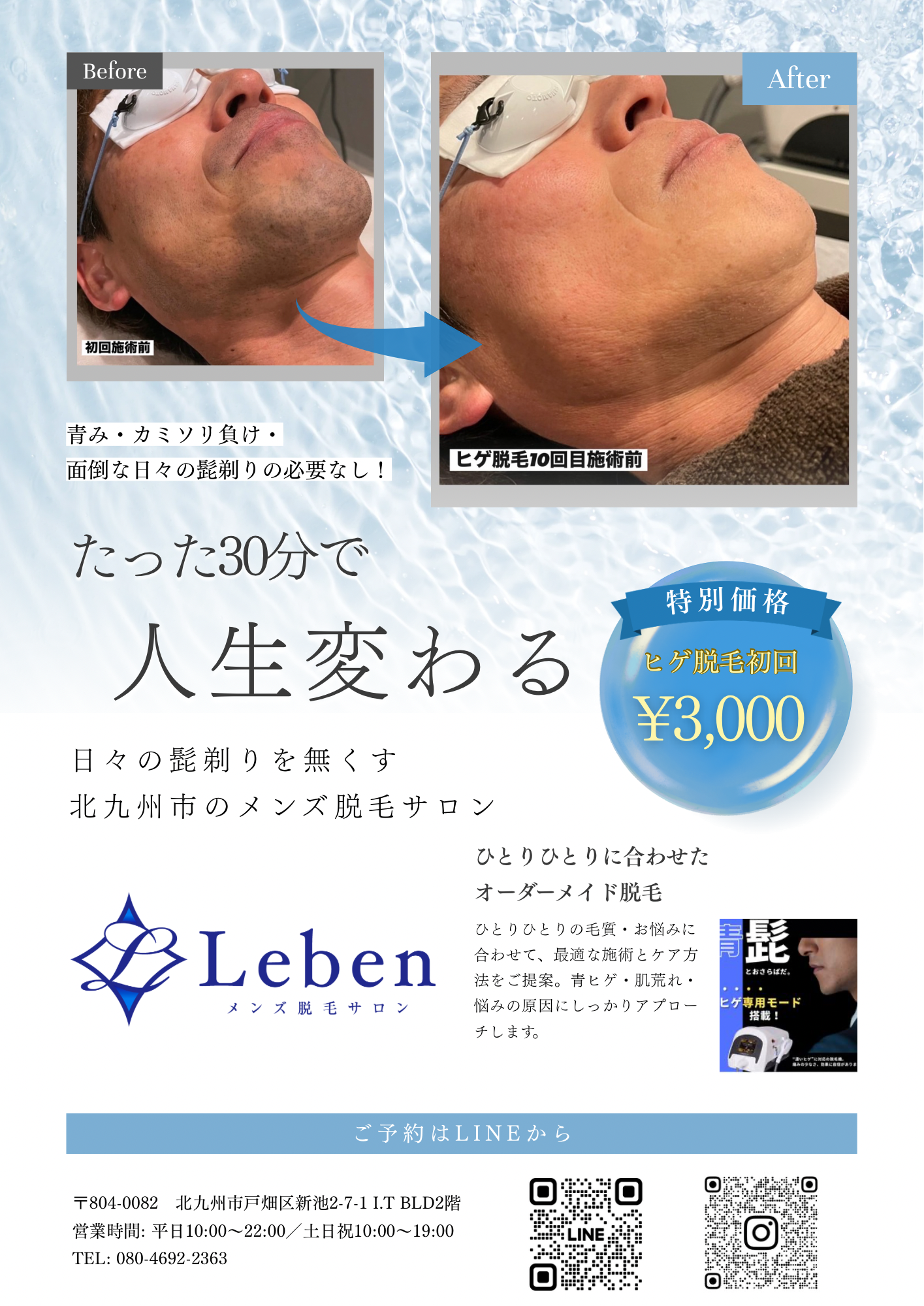 ヒゲ脱毛はたったの30分‼️