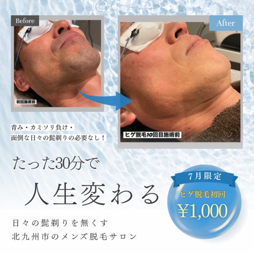 7月限定！ヒゲ脱毛！