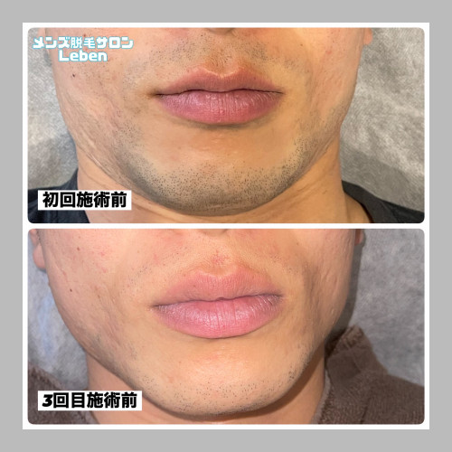 北九州市でヒゲ脱毛するならLeben‼️