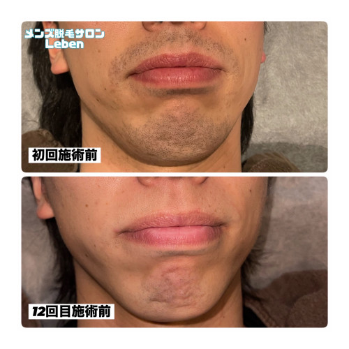 青ヒゲはなくなる‼️