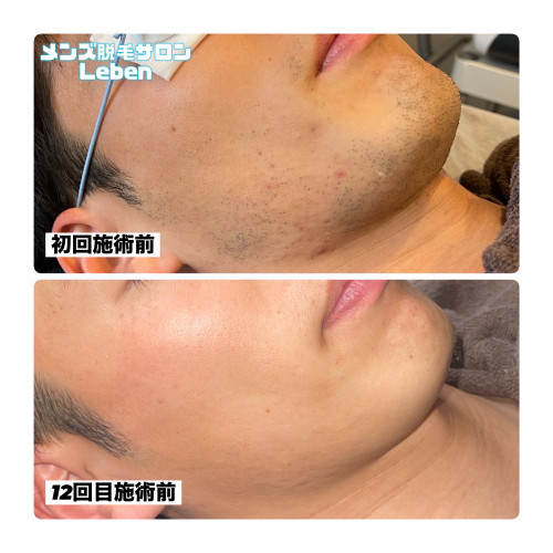 ヒゲ脱毛5回で30,000円‼️