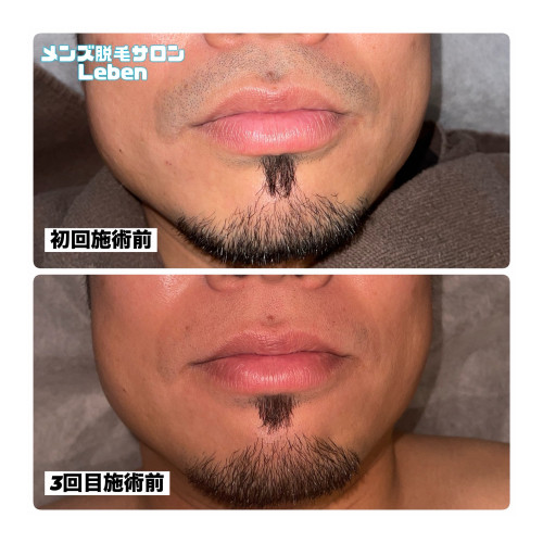 青ヒゲ気になりませんか？