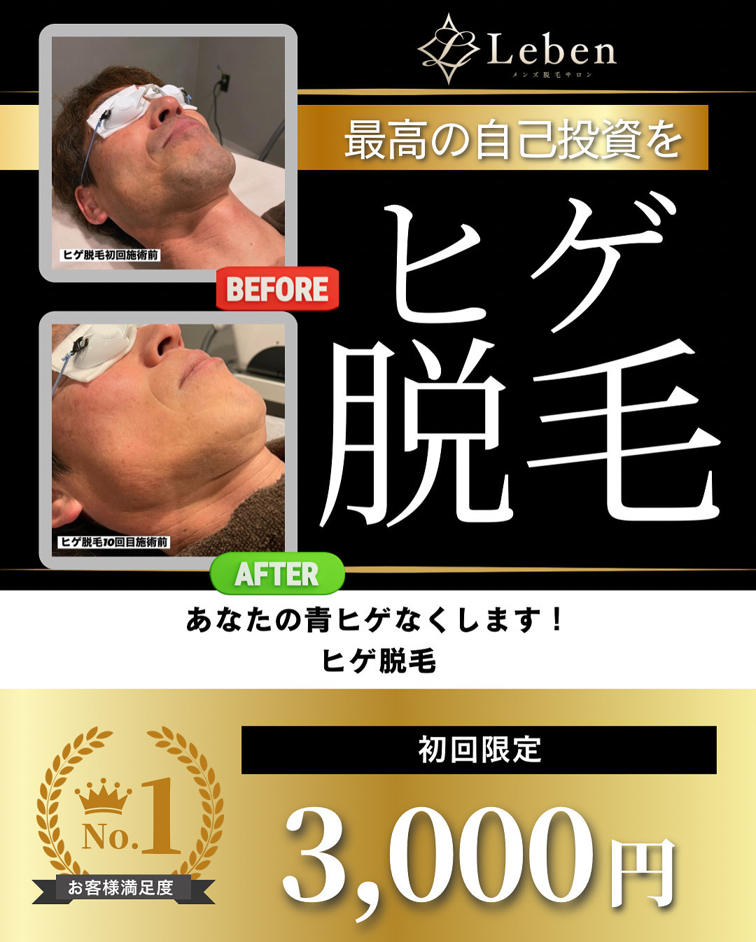 ヒゲ脱毛してください🙇🙇