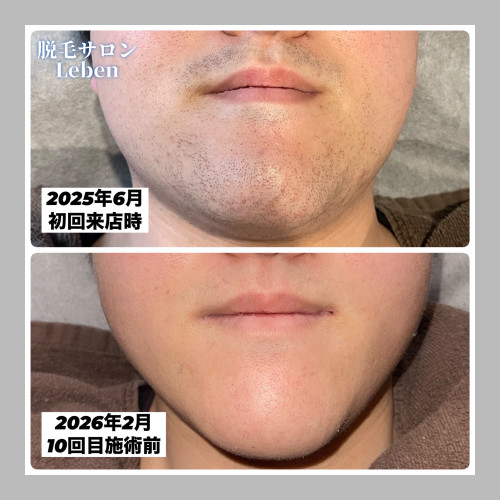 ヒゲ脱毛の変化