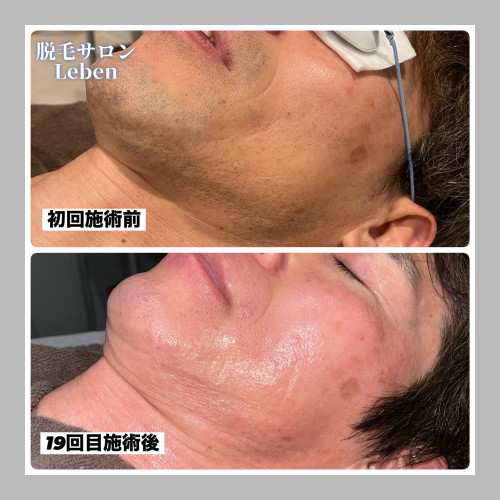 北九州市ヒゲ脱毛