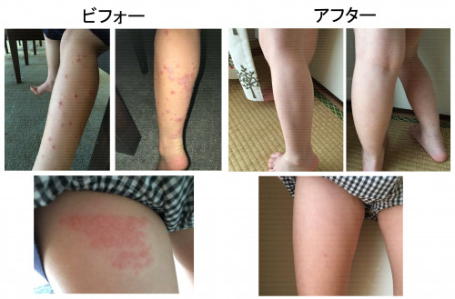 アレルギーについて