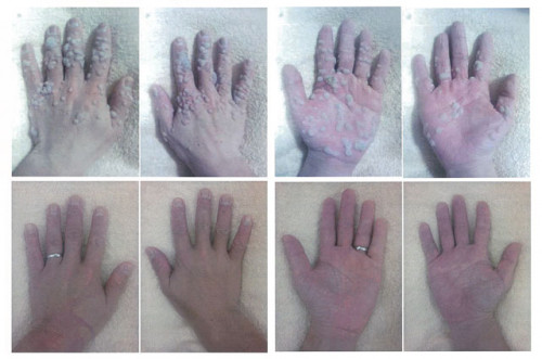 汗と金属イオンの症例