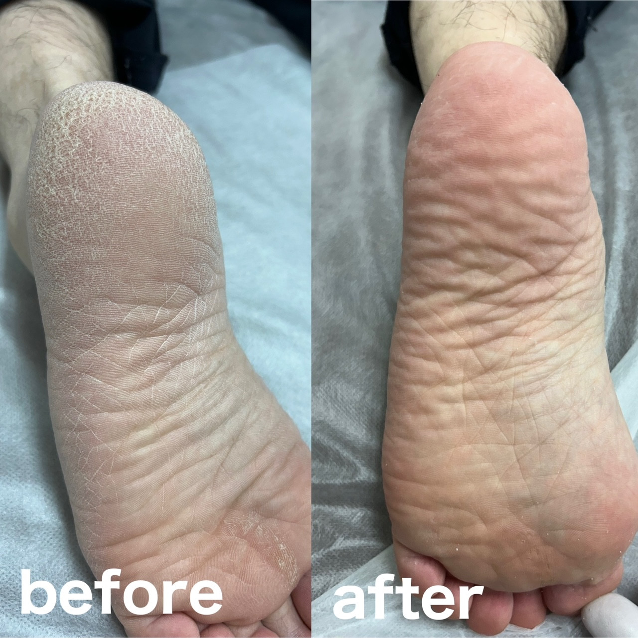 フット角質ケア施術の様子BeforeAfter