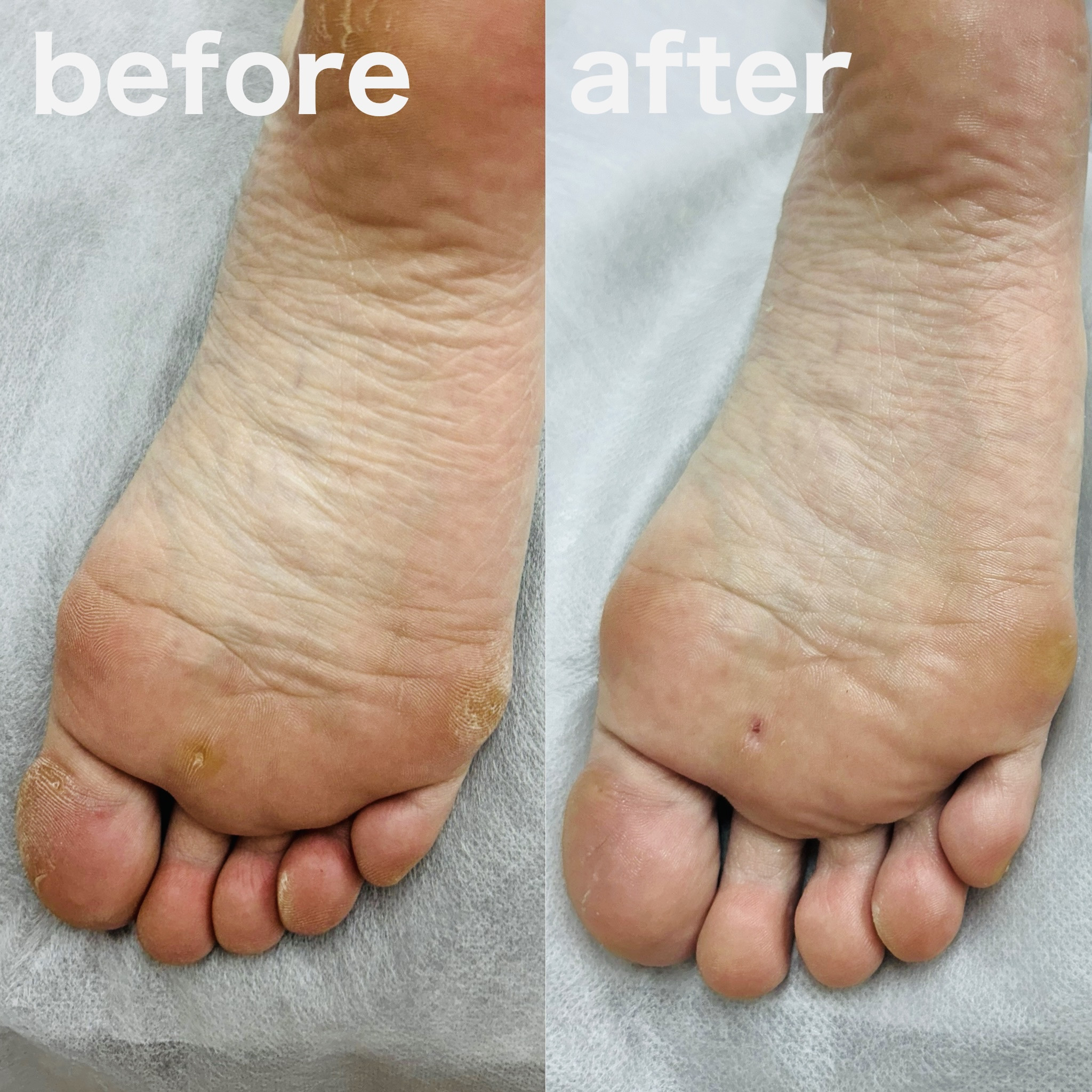 ウオノメケア BeforeAfter