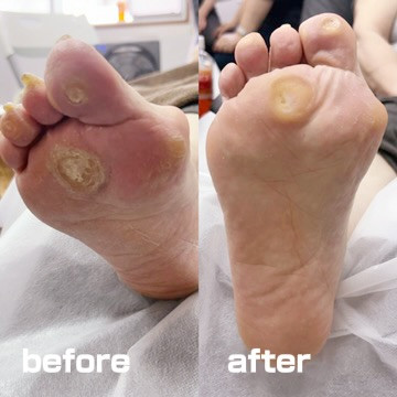 タコケア BeforeAfter