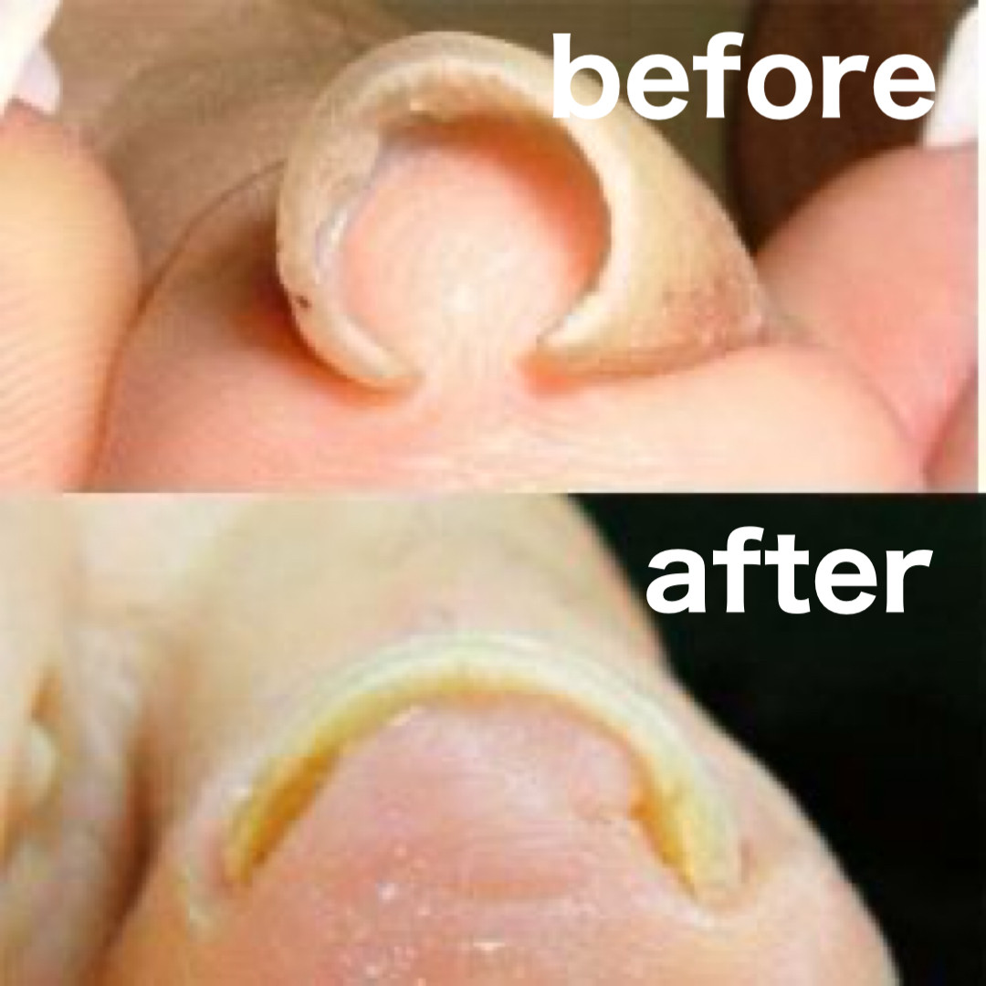 巻き爪補正 before after