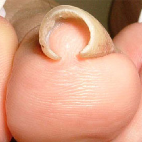 巻き爪補正 before